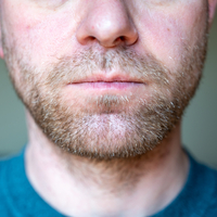 Çene çıkığı nedir?