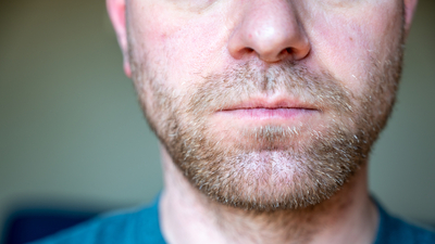 Çene çıkığı nedir?