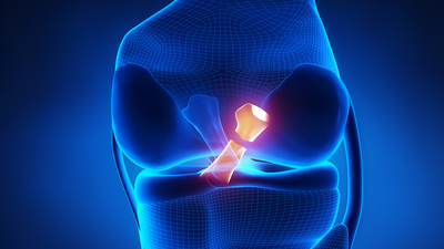 Çapraz bağ kopması nedir?