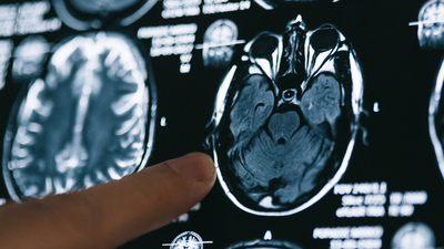 O aşıyı yaptıranlarda Alzheimer riski daha düşük