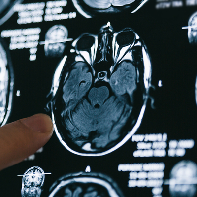 O aşıyı yaptıranlarda Alzheimer riski daha düşük