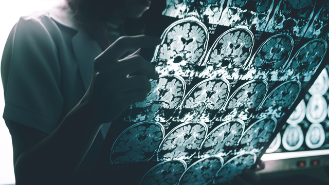 Covid-19, Alzheimer ve beyin kanaması riskini artırır mı?