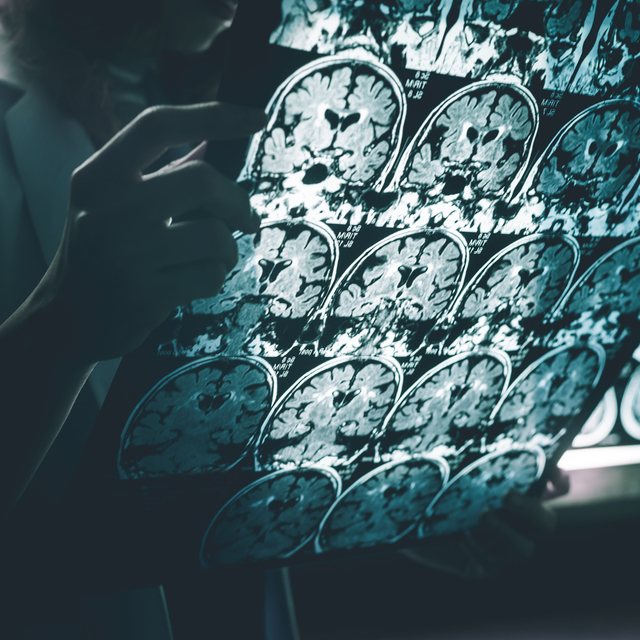 Covid-19, Alzheimer ve beyin kanaması riskini artırır mı?