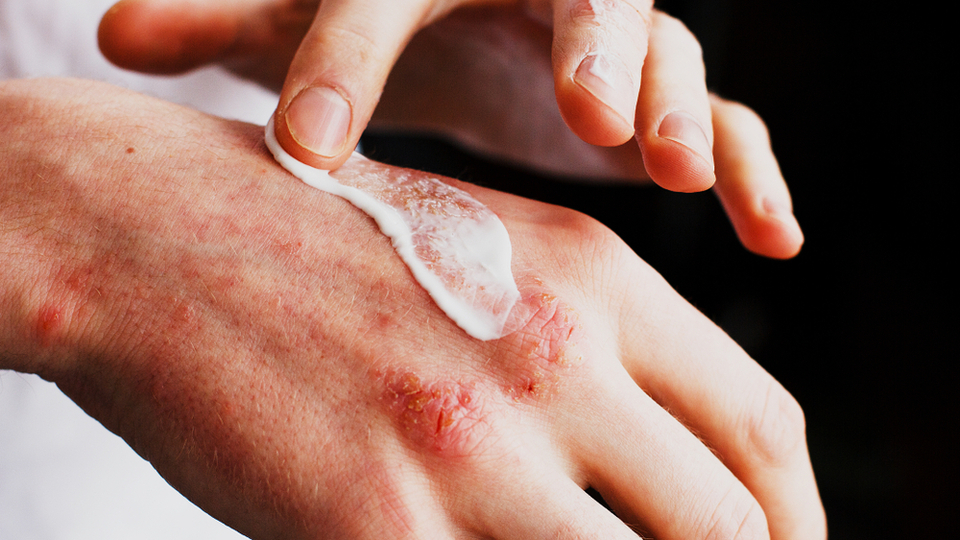 Strese bağlı egzama belirtileri