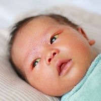 Yenidoğan bebekte sarılık belirtileri