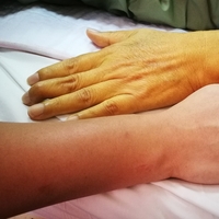 Yetişkinlerde sarılık belirtileri