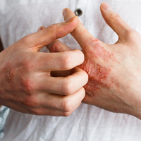 El egzaması belirtileri