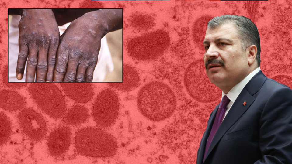 Türkiye'de ilk maymun çiçeği vakası