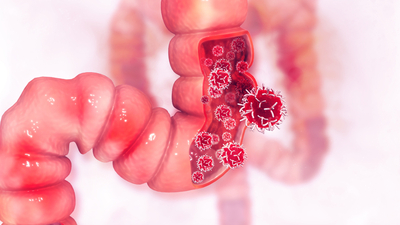 Kolon kanseri belirtileri