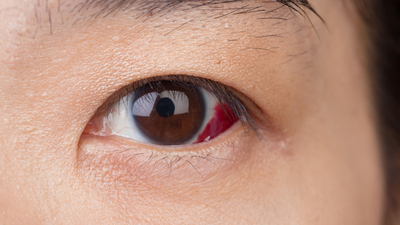 Retina yırtılması belirtileri