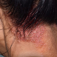 Saçkıran bitkisel tedavi yolları!