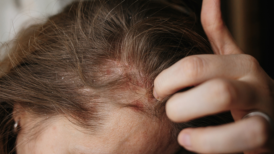 Saçta egzama belirtileri ve tedavisi