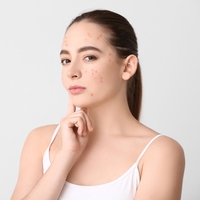 Sivilceye ne iyi gelir?