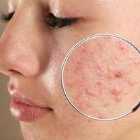 Evde sivilce nasıl geçer?