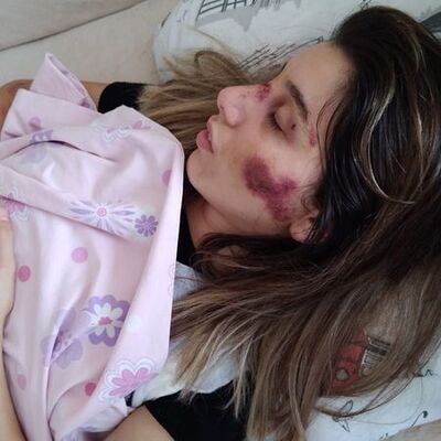 Ters yönde dehşet! Scooterlı hemşireye çarptı