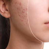 Sivilce izlerine iyi gelen şeyler