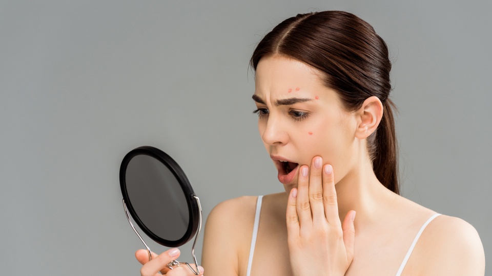 Sivilce izleri nasıl geçer?