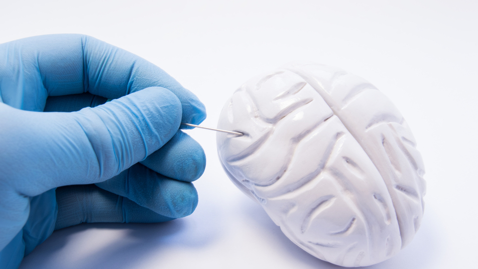 Beyin Tümörü Belirtileri ve Tedavisi