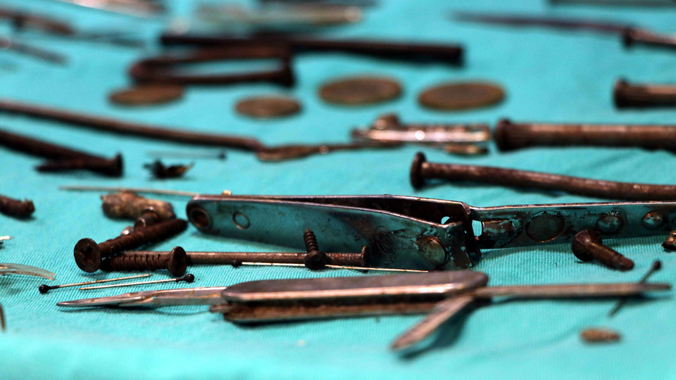 Şoke eden olay! Midesinden çıkanlar şaşkına çevirdi