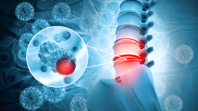 Kemik kanseri belirtileri ve tedavisi