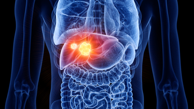 Karaciğer Kanseri Nedir?