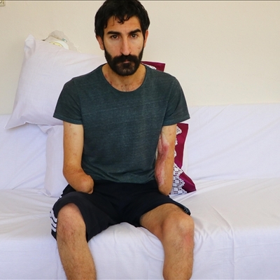 Kollarını ve bacağını kaybetti! Tek isteği kol nakli