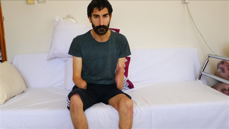 Kollarını ve bacağını kaybetti! Tek isteği kol nakli