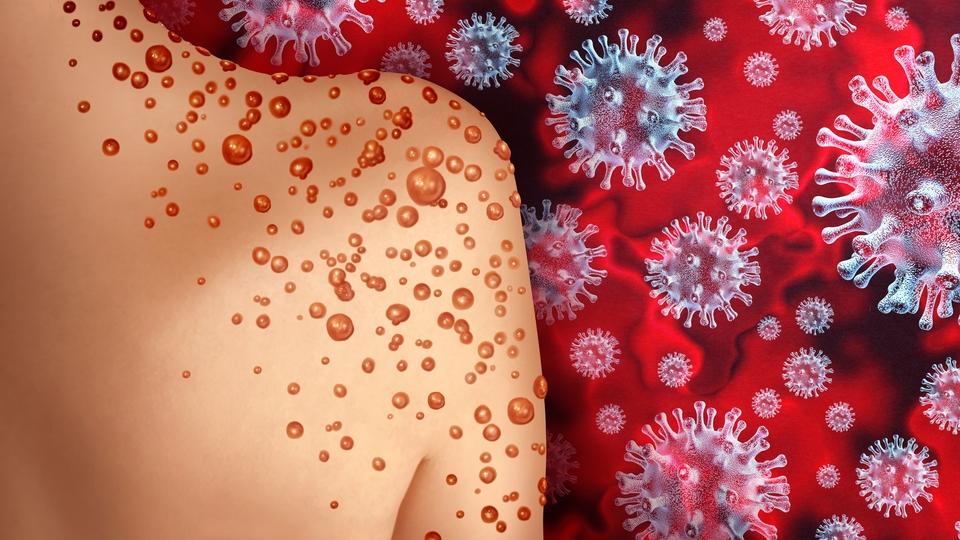 Sağlık Bakanlığı 'maymun çiçeği' rehberi yayınladı