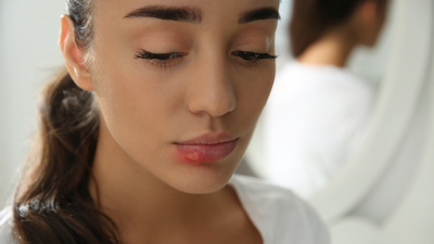 Uçuğa ne iyi gelir?