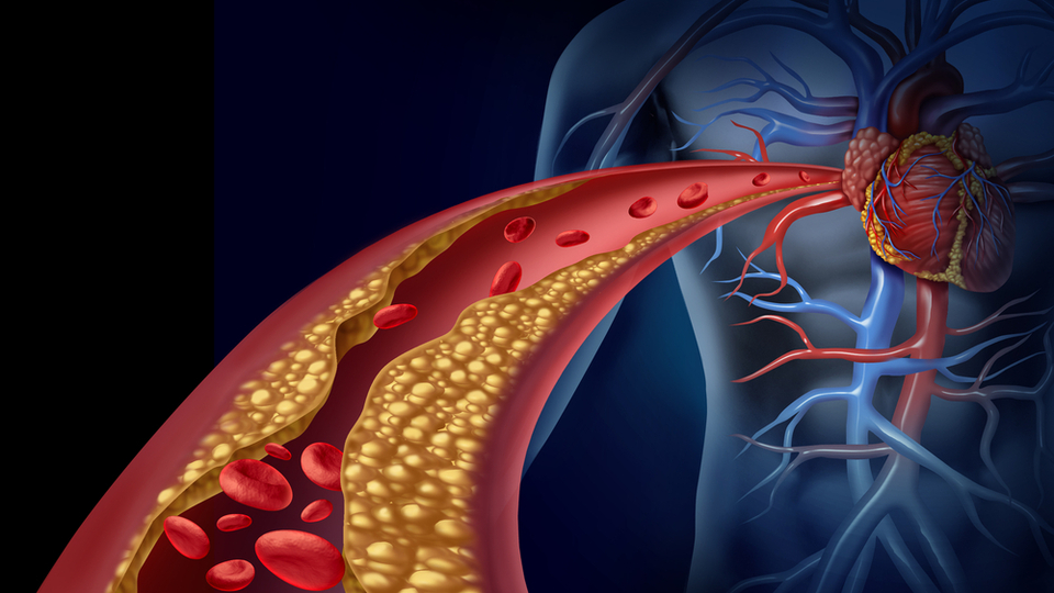 Damar tıkanıklığı belirtileri ve tedavisi