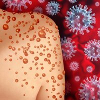 Maymun çiçeğinden Avrupa'da ilk ölüm