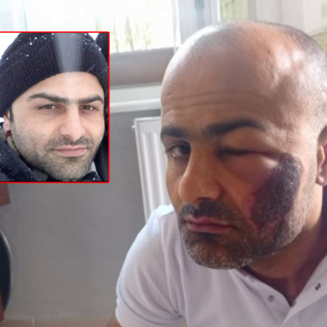 Lazer epilasyondan sonra tanınmaz hale geldi