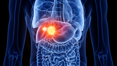 Karaciğer 4. evre hastası ne kadar yaşar?