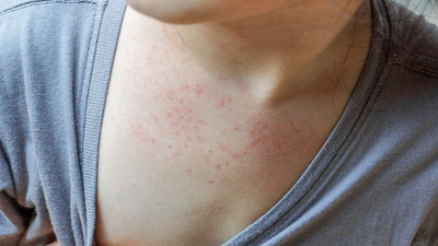 Gül hastalığı nedir, neden olur?