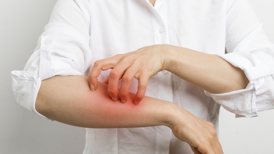 Uyuz belirtileri ve tedavisi