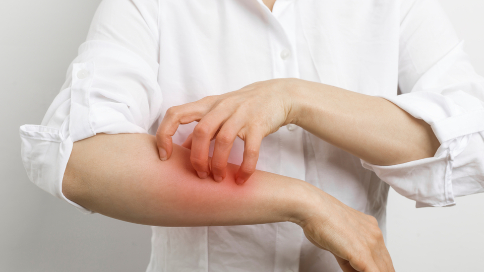 Uyuz belirtileri ve tedavisi