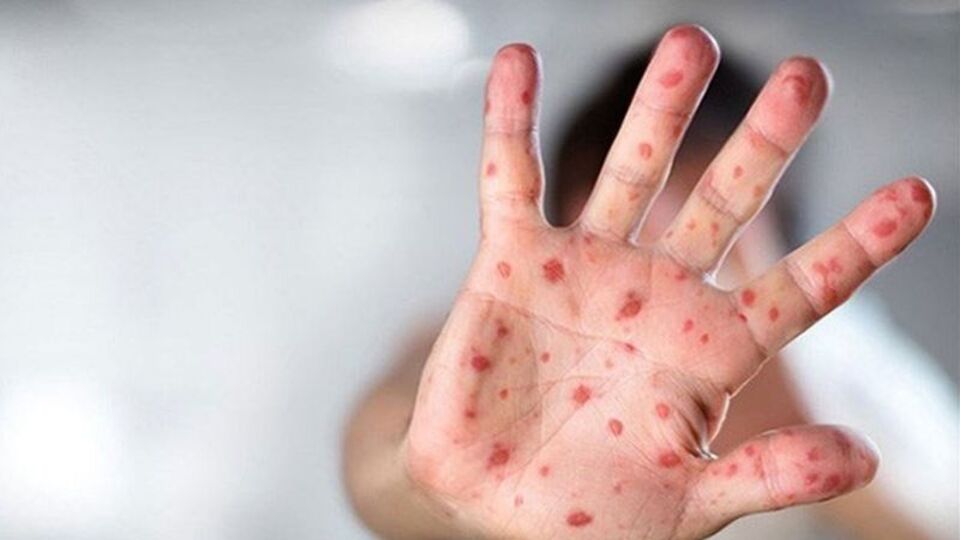 İşte çiçek aşısının maymun çiçeğine karşı koruma oranı