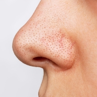 Siyah nokta neden olur ve nasıl geçer?