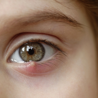 Arpacık neden çıkar, nasıl geçer?