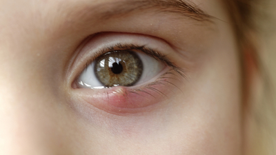 Arpacık neden çıkar, nasıl geçer?