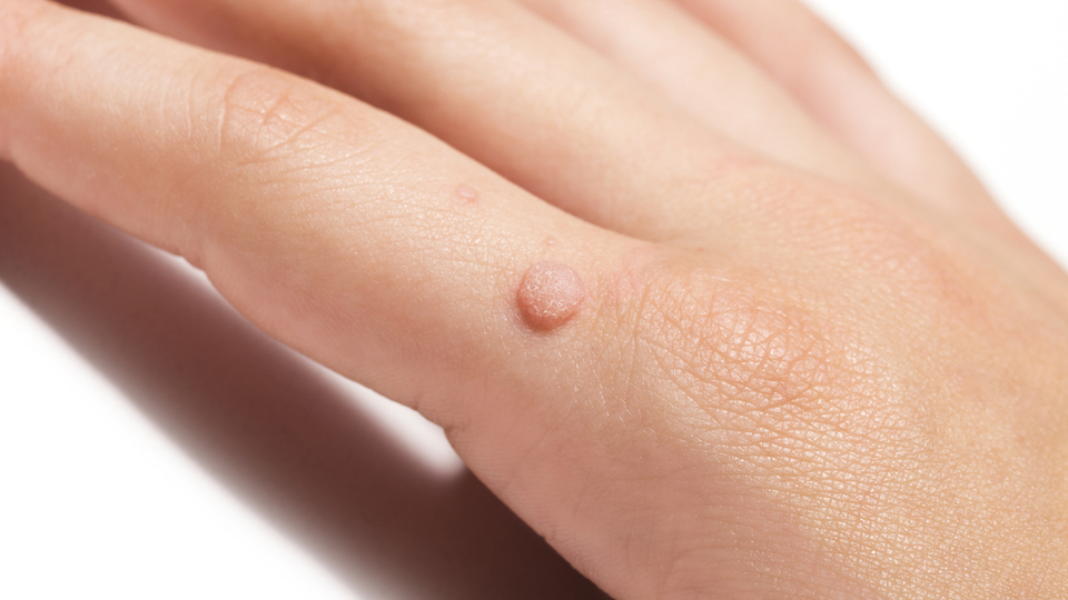 Siğil nedir, neden olur ve nasıl geçer?
