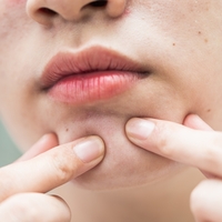 Yağ bezesi neden olur ve nasıl geçer?