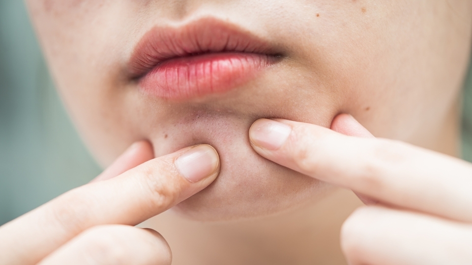 Yağ bezesi neden olur ve nasıl geçer?