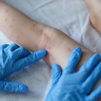 Koronavirüs ve maymun çiçeğinin ardından yeni salgın alarmı!