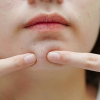 Yağ bezesine iyi gelen şeyler ve doğal çözümler