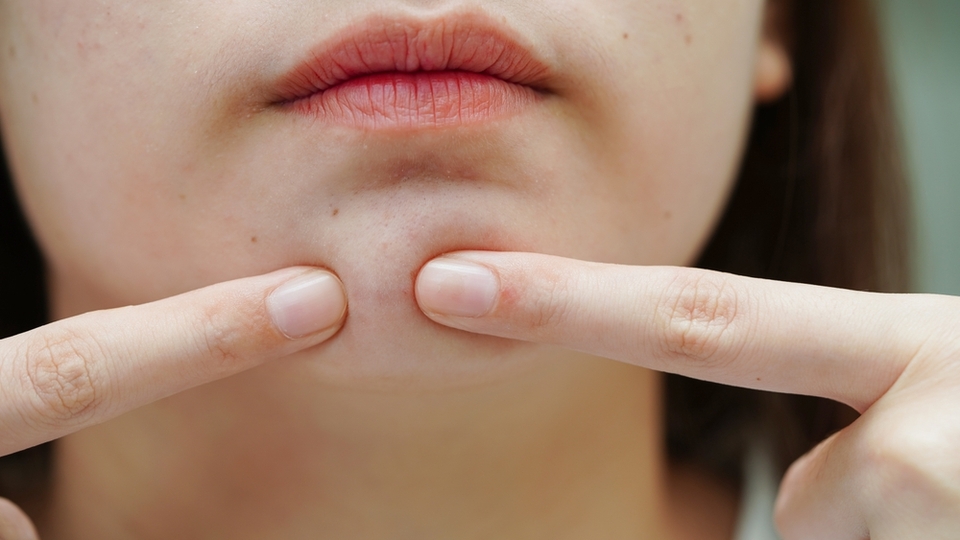 Yağ bezesine iyi gelen şeyler ve doğal çözümler