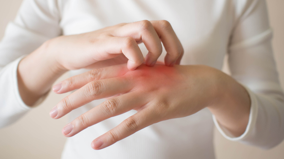 Egzama neden olur ve nasıl geçer?