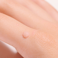 Siğile iyi gelen şeyler ve doğal yöntemler