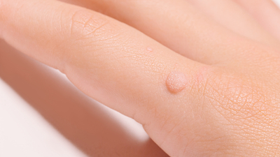 Siğile iyi gelen şeyler ve doğal yöntemler