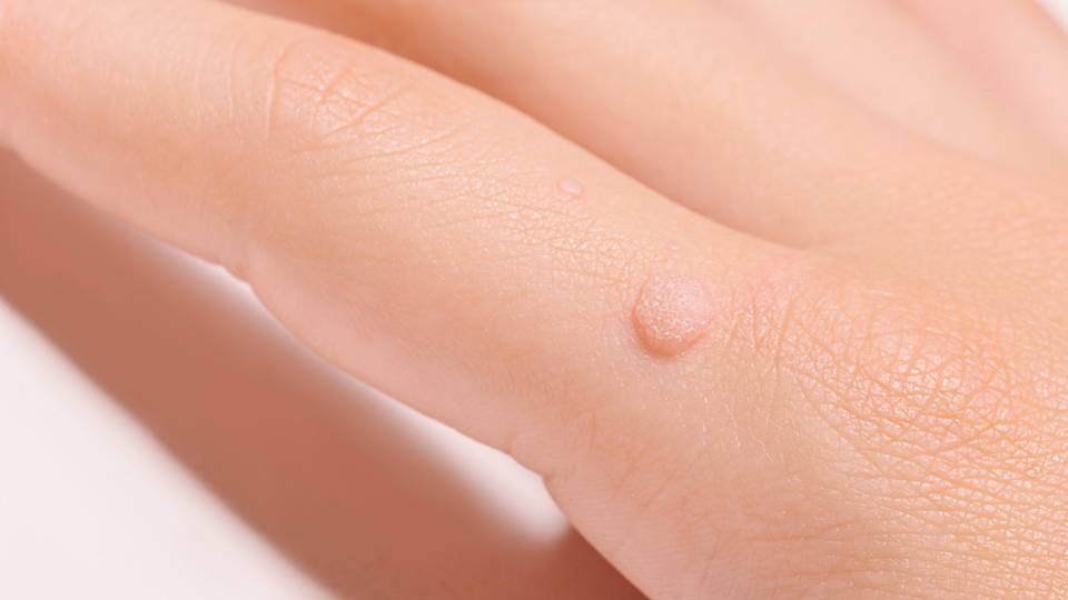 Siğile iyi gelen şeyler ve doğal yöntemler